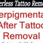 Tattoo Removal Cream Alternative – Is Tca Tat Removal Pleasant?