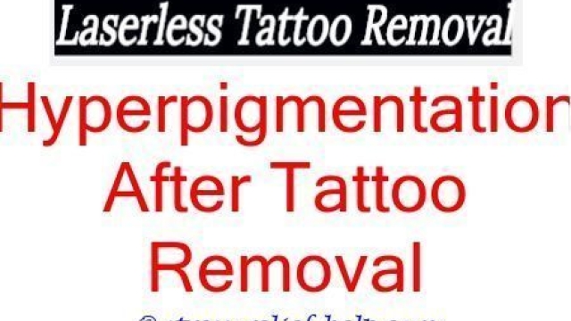 Tattoo Removal Cream Alternative – Is Tca Tat Removal Pleasant?