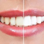 Sparkling Smiles: Unveiling the Top Teeth Whitening Products