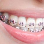 Choosing the Right Dental Care: Orthodontist vs. Private Dentist